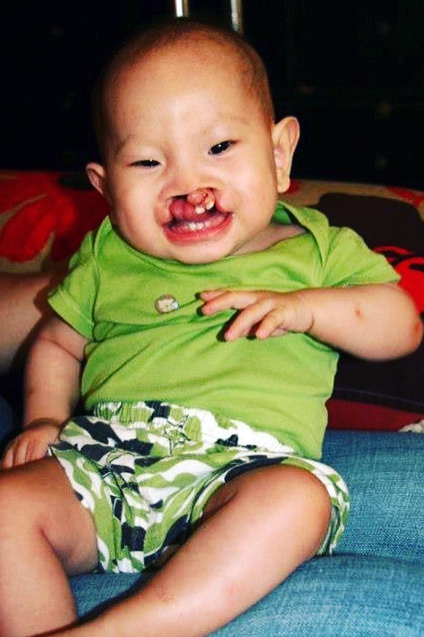 Jamie at SFCV prior to first surgery for bilateral cleft lip and palate