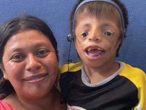 ten-year-old boy with TCS with his mama. the boy is wearing an external hearing device and has facial abnormalities.