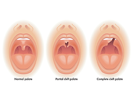 classification of cleft palate