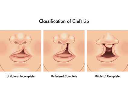 sketches showing the classification of cleft lip