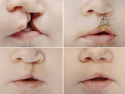 photos showing the surgical repair and healing of cleft lip